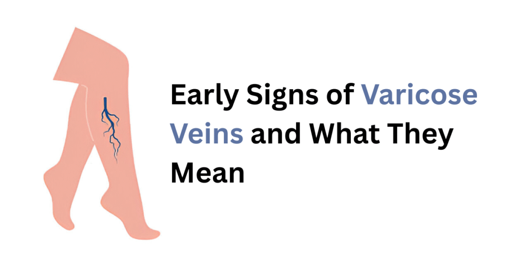 Signs of Varicose Veins.
