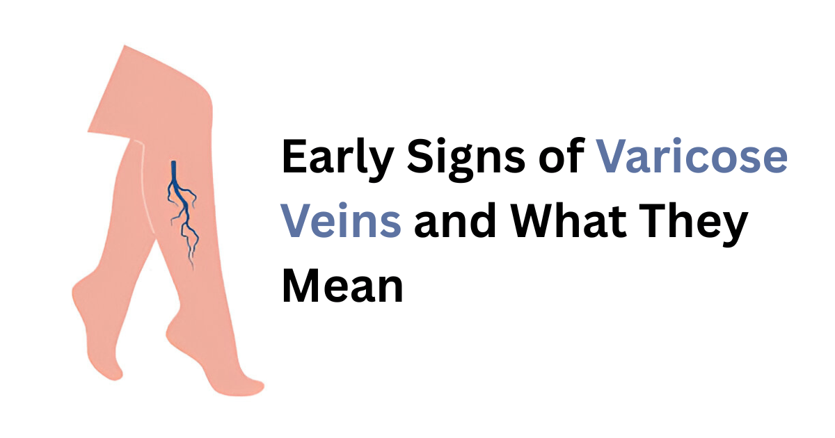 Signs of Varicose Veins.