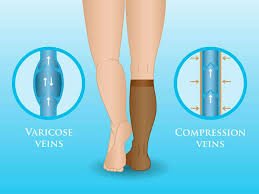 compression therapy