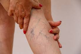 Vein Care clinic