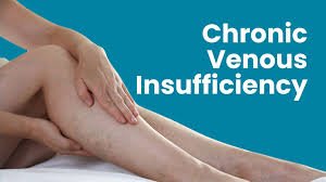 chronic venous insufficiency